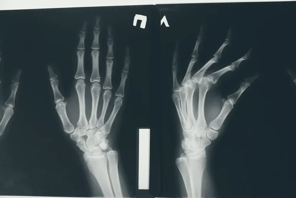 Radiografias de duas mãos sobre um negatoscópio, mostrando os ossos do carpo e dos dedos.